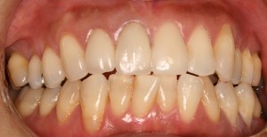 錦織②-6　左上1OS装着